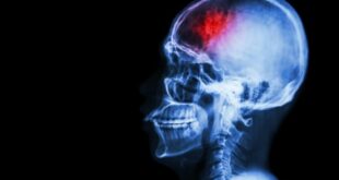 Σιωπηρό εγκεφαλικό: Για ποια ασθένεια διπλασιάζει τις πιθανότητες