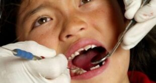 Τι είναι οι προληπτικές καλύψεις οπών και σχισμών των παιδικών δοντιών;