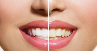 Ποιες τροφές κιτρινίζουν τα δόντια και τι μπορείτε να κάνετε γι’ αυτό