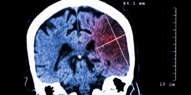 Lancet: Ο παγκόσμιος «χάρτης κινδύνου» για τα εγκεφαλικά