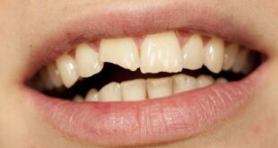Τραυματισμοί των δοντιών: Ποιες είναι οι πρώτες βοήθειες;