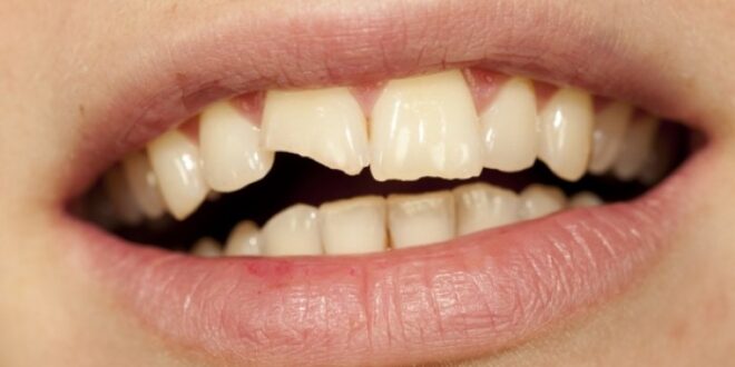 Τραυματισμοί των δοντιών: Ποιες είναι οι πρώτες βοήθειες;