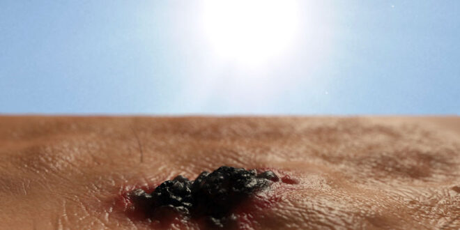 Καρκίνος δέρματος Τα προειδοποιητικά σημάδια μέσα από φωτογραφίες