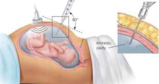 Αμνιοπαρακέντηση ή αμνιοκέντηση Τι είναι και πώς γίνεται