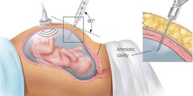 Αμνιοπαρακέντηση ή αμνιοκέντηση Τι είναι και πώς γίνεται