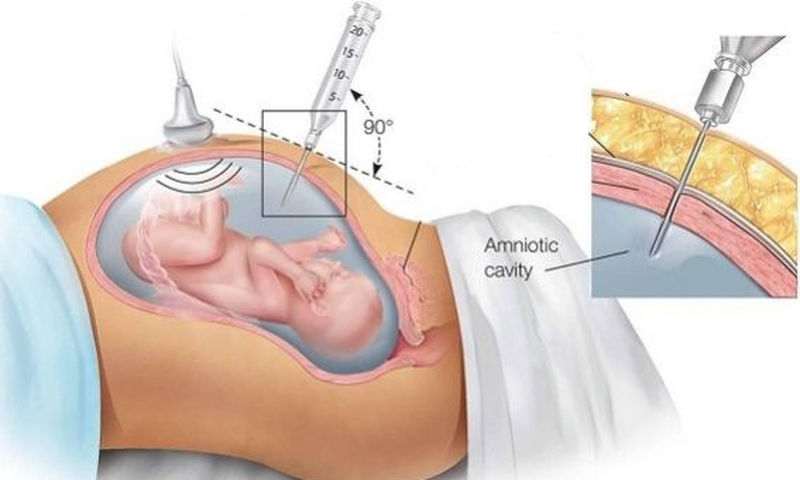 Αμνιοπαρακέντηση ή αμνιοκέντηση Τι είναι και πώς γίνεται