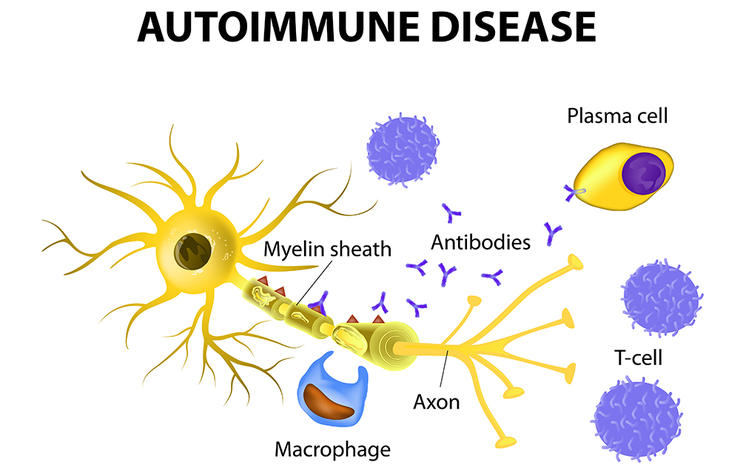 shutterstock 251497936 autoimmune disease designua