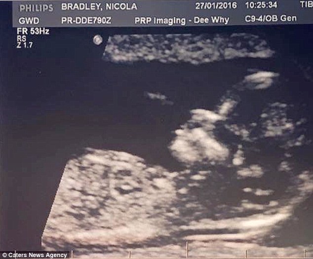 Her parents were in disbelief when an ultrasound (above) revealed she had hair after just weeks in the womb