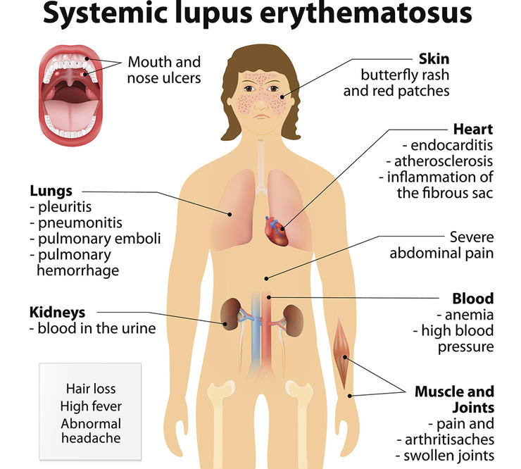 gettyimages 481396564 lupus ttsz