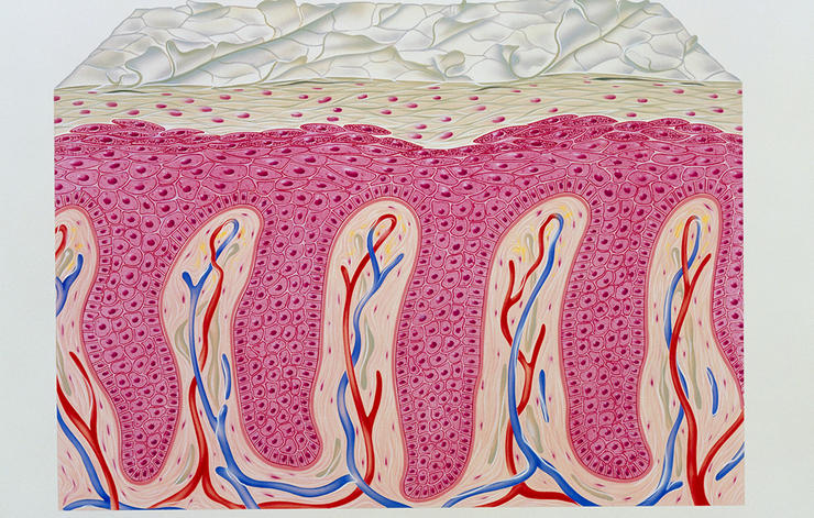 gettyimages 680795271 psoriasis john bavosi science photo library