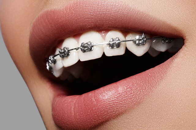 bigstock Beautiful White Teeth With Bra 173925898