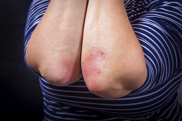 bigstock Psoriasis On Elbow 198070495