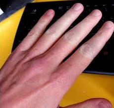 raynaud2