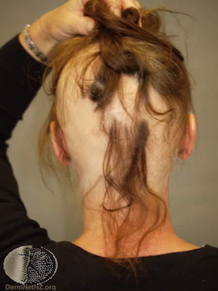 alopekia