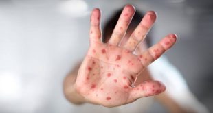 Αναζωπυρώθηκε η ιλαρά σε όλο τον κόσμο