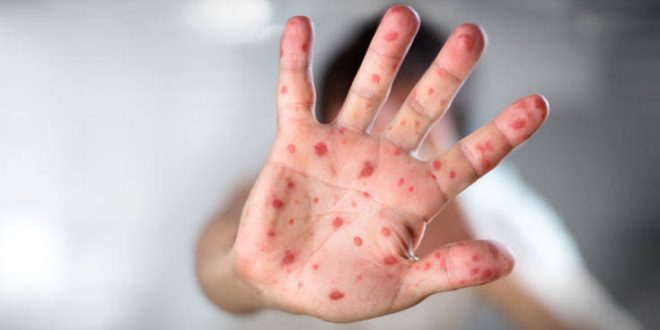 Αναζωπυρώθηκε η ιλαρά σε όλο τον κόσμο