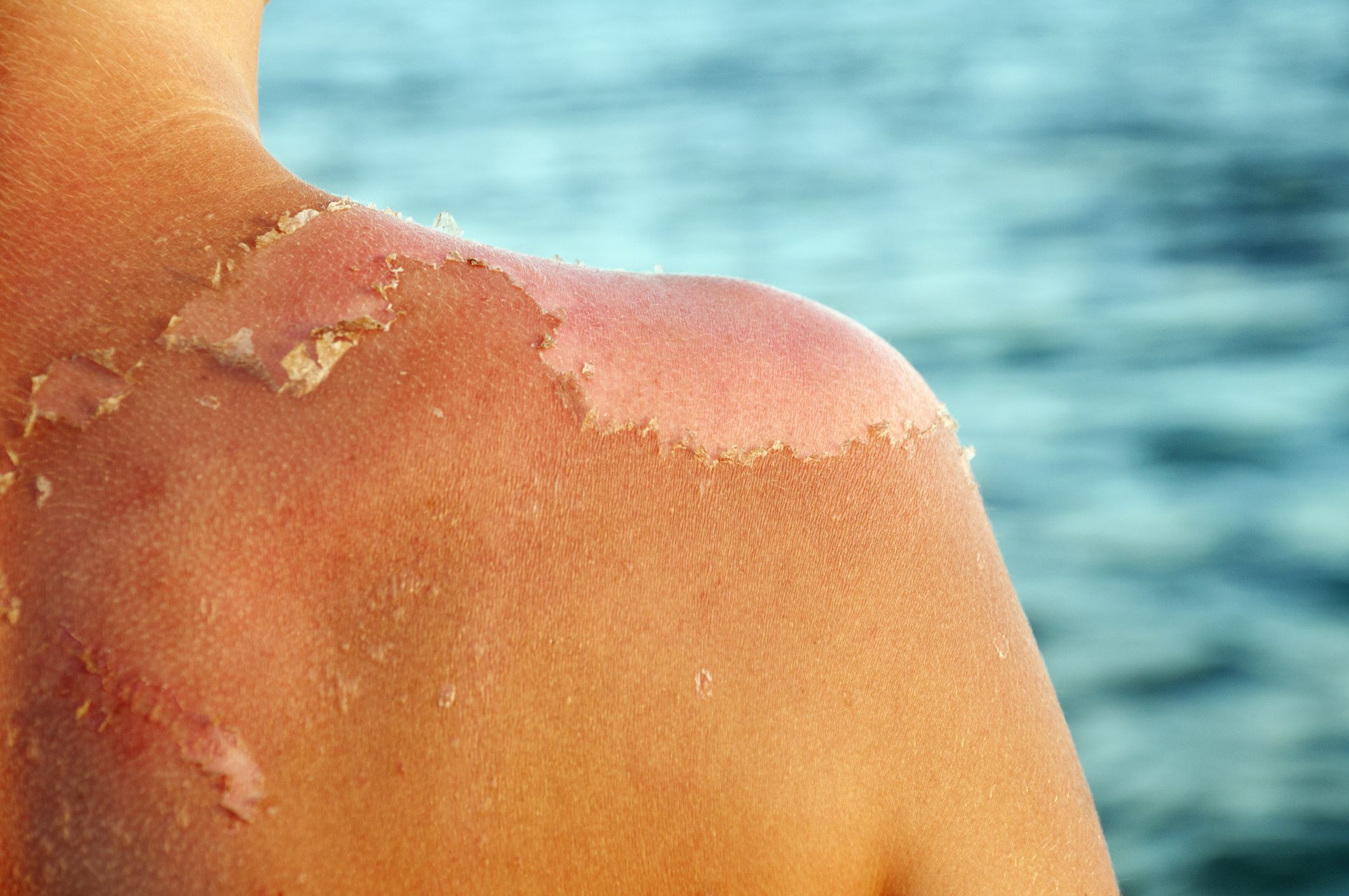 skin peeling royalty free image 175383361 1555595765