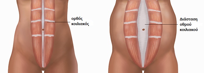 DiastasisRectusAbd LG