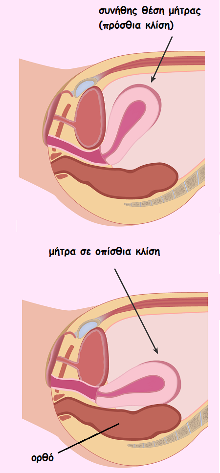 retroverted uterus