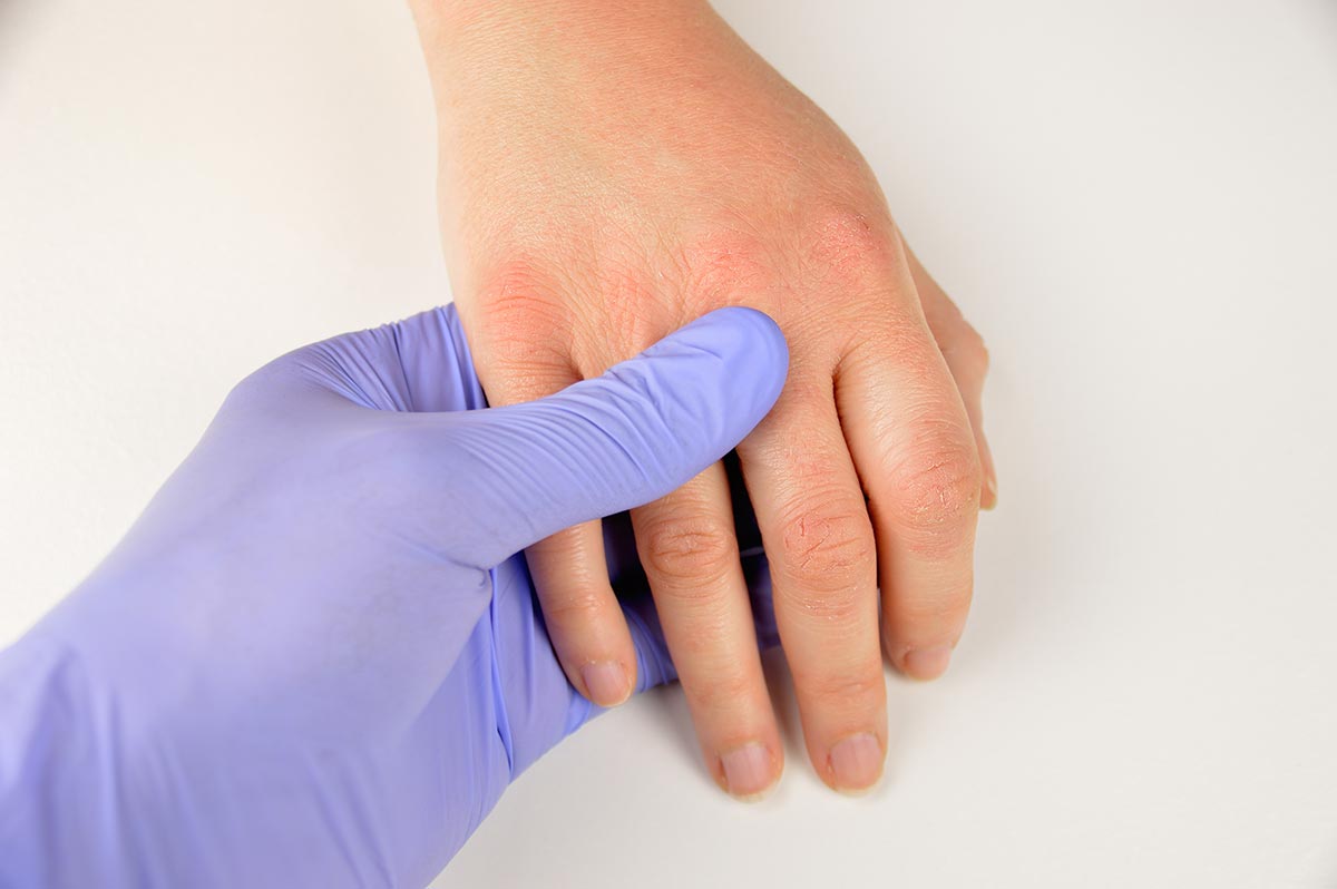 atopiki dermatitida 4