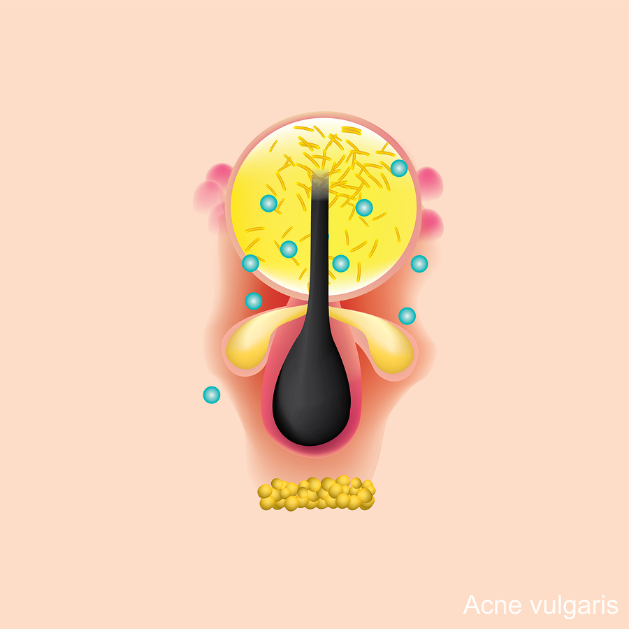 bigstock Acne Vulgarise Is A Long term 324372448