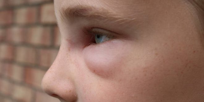 Το 7χρονο αγόρι που είναι αλλεργικό στον χειμώνα