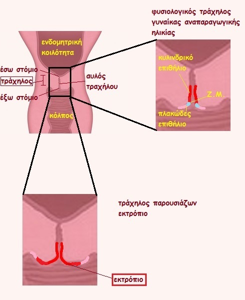 ektropio trahilou 2