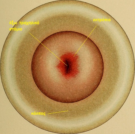 ektropio trahilou 3