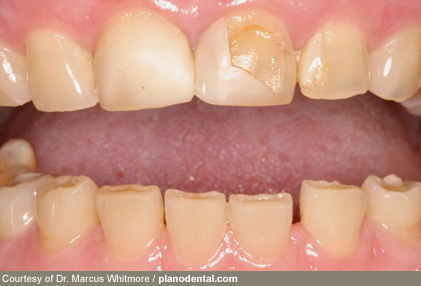 2whitmore rf photo of bruxism teeth