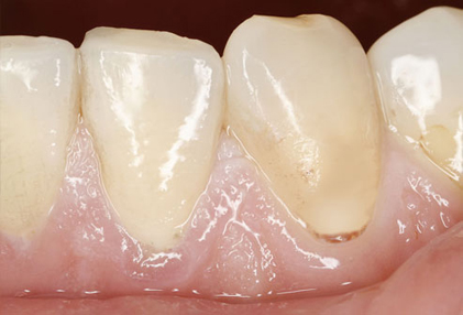 4photolibrary rf photo of white teeth