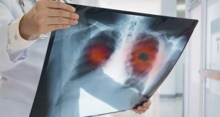 Αυξημένος ο κίνδυνος καρκίνου των πνευμόνων για ασθενείς με ΧΑΠ που δεν κάπνισαν ποτέ