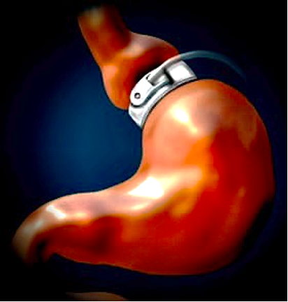 gastric bypass