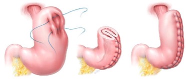 gastric plication
