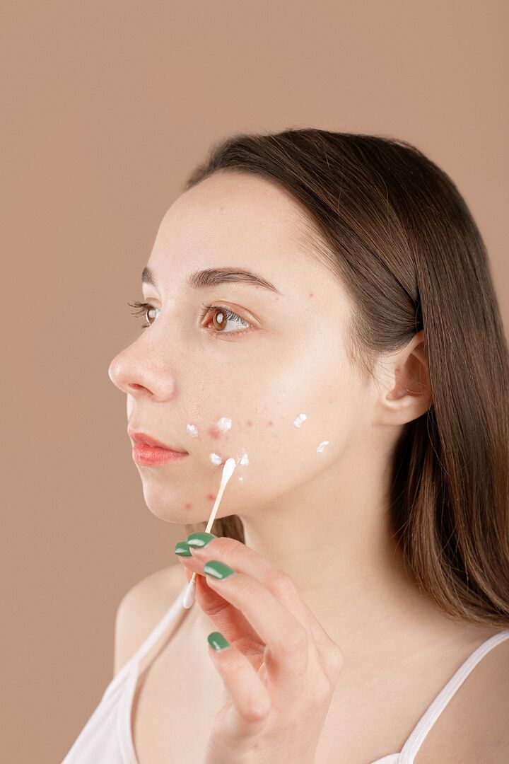 pimples