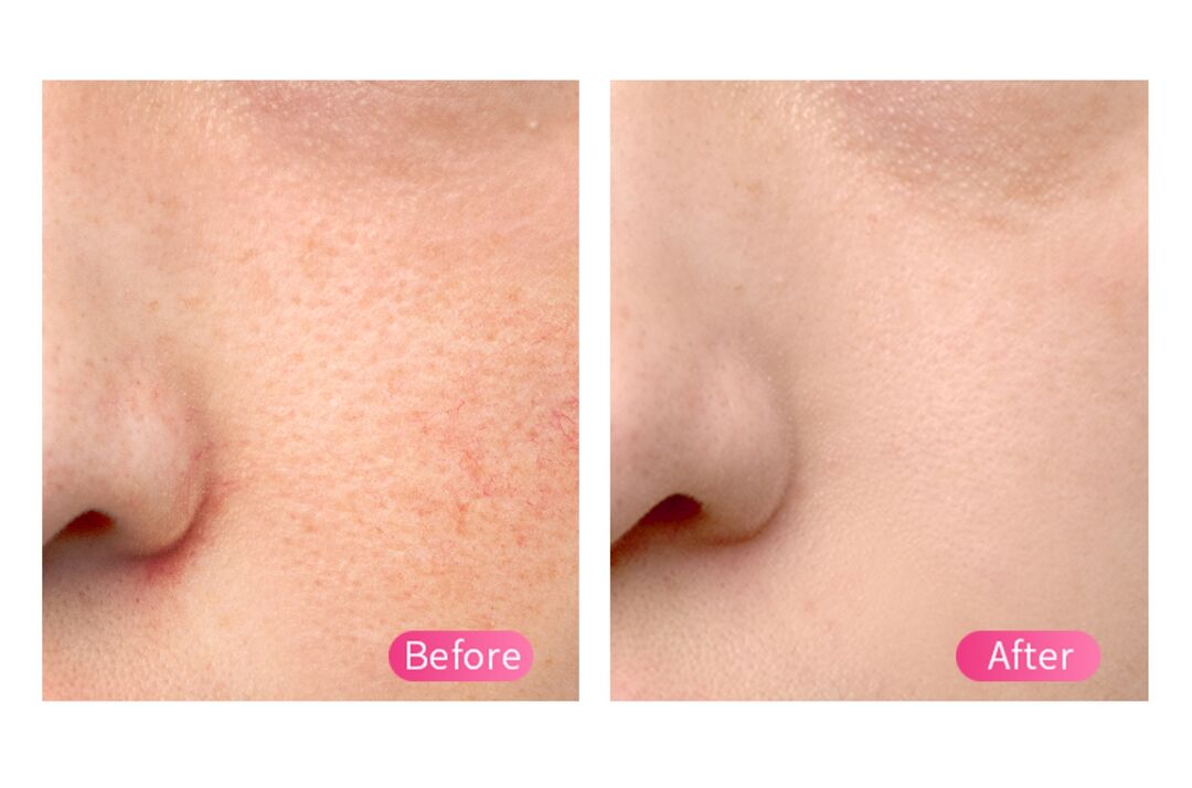 FOREO Cryo Therapy Before After pic