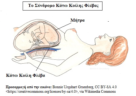 Supine hypotensive syndrome 2