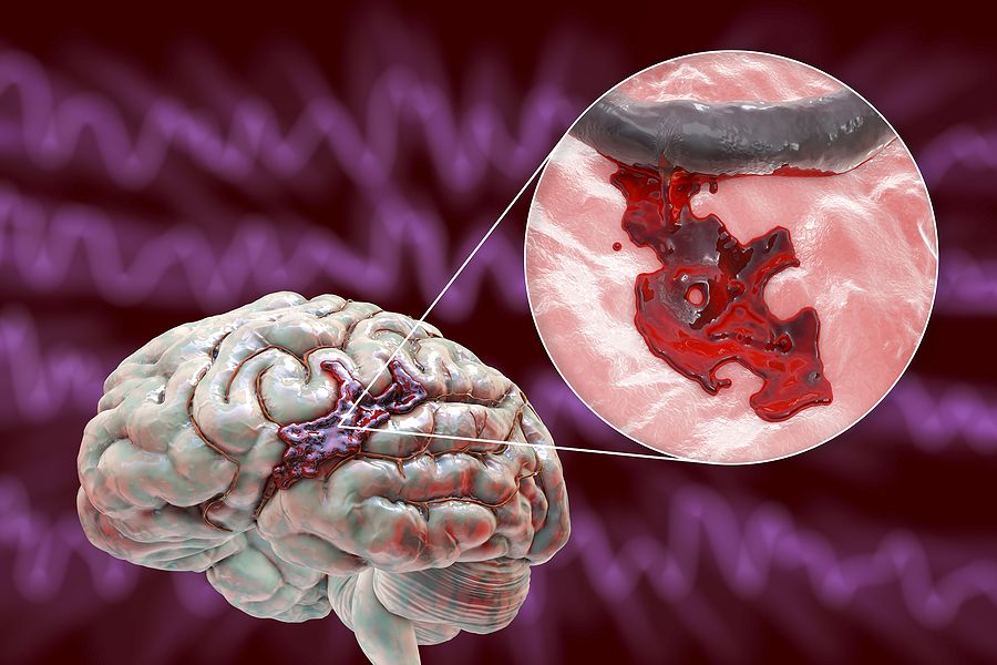 Hemorrhagic Stroke, 3d Illustration Showing Hemorrhage On The Brain Surface And Closeup View Of The
