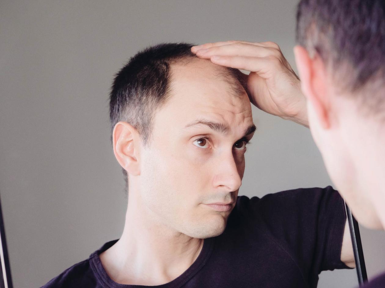 Male Pattern Hair Loss Problem Concept. Young Caucasian Man Looking At Mirror Worried About Balding.