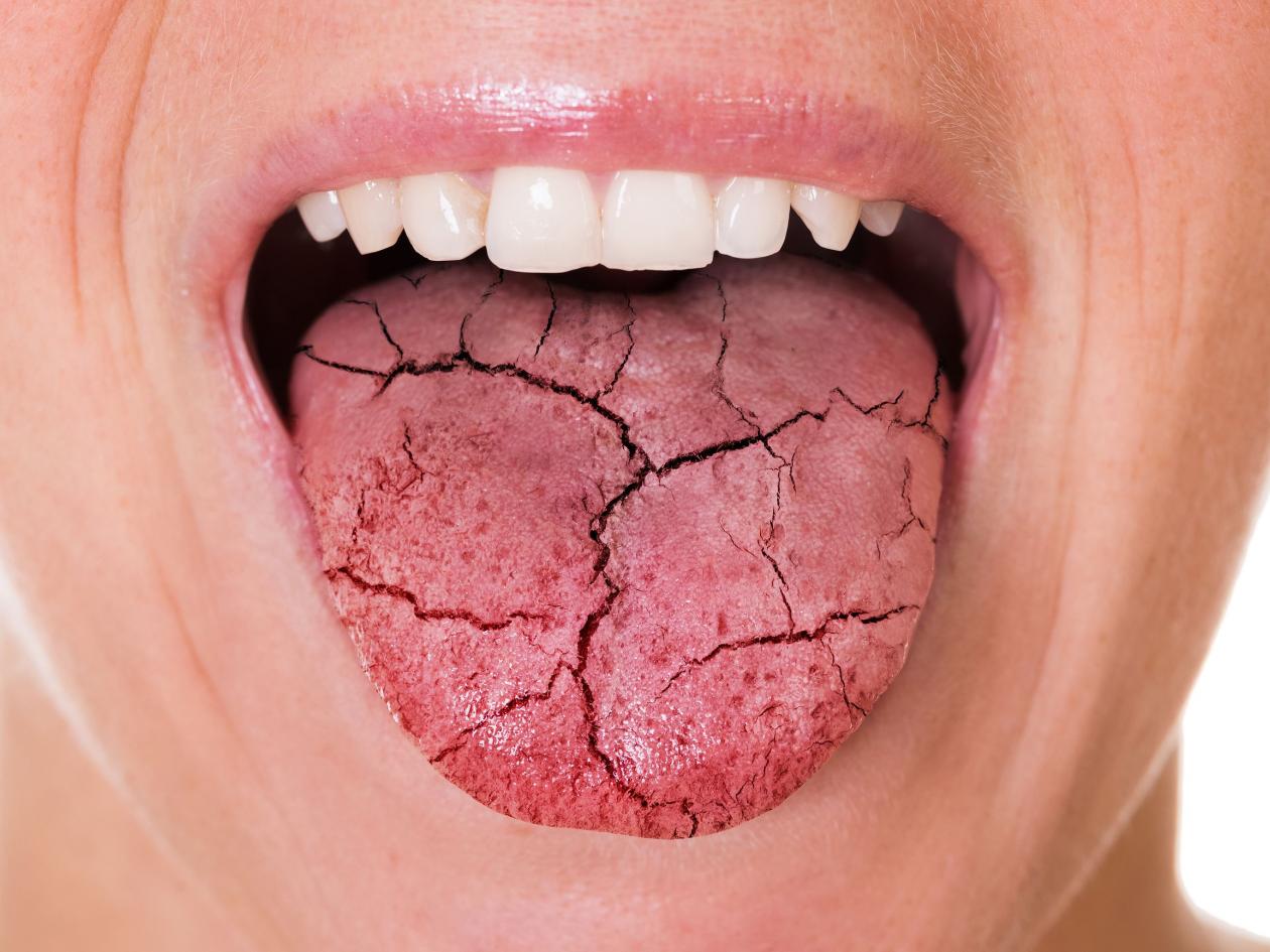 Woman Mouth And Broken Tongue With Cracks