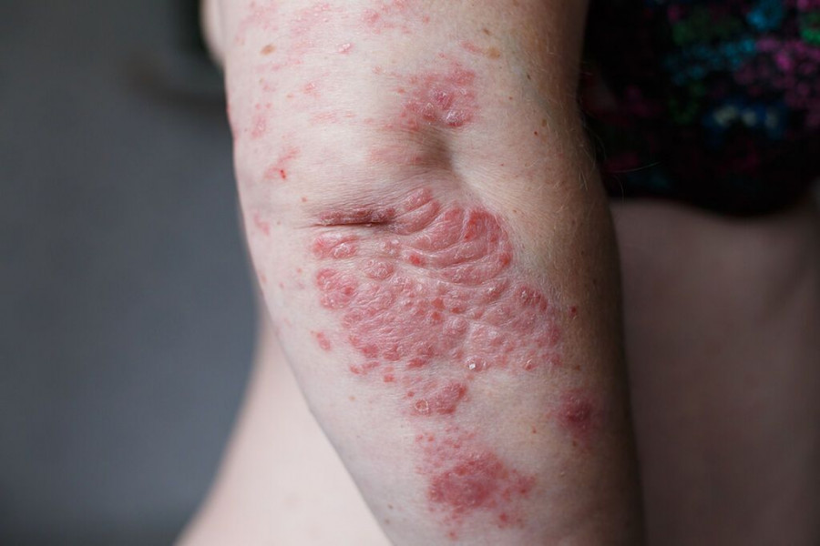 1643645761217-190896736-bigstock-Psoriasis-Skin-Psoriasis-Is-A-230538382.jpg