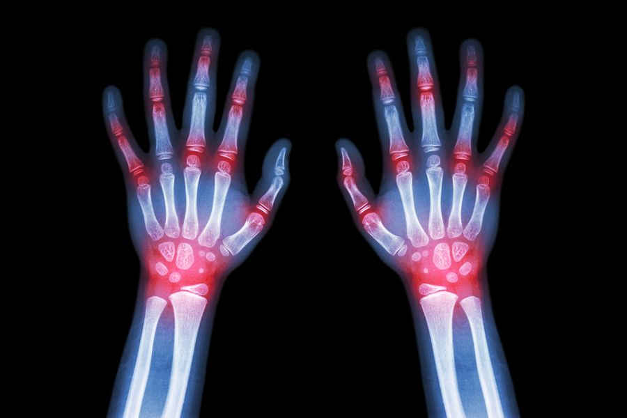 bigstock-Rheumatoid-Arthritis-Gout-Ar-103755428.jpg