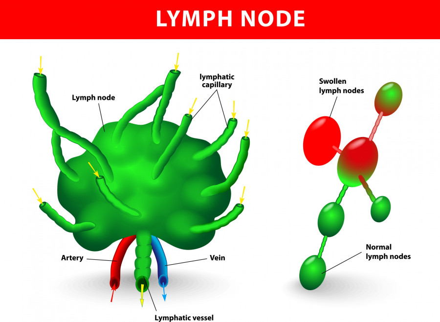 lymph-node-gland-lemfadenes