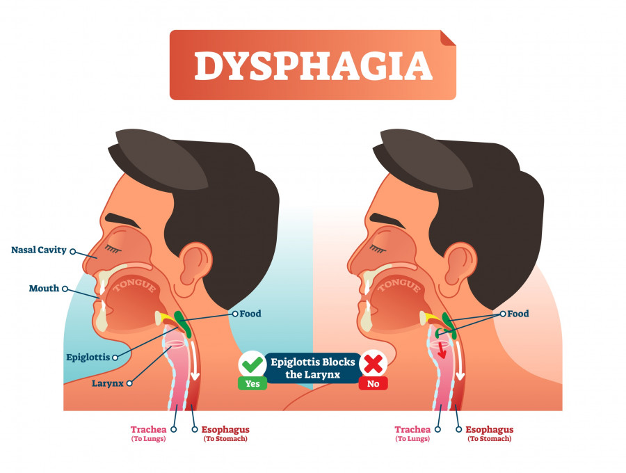 Dysphagia-dysfagia