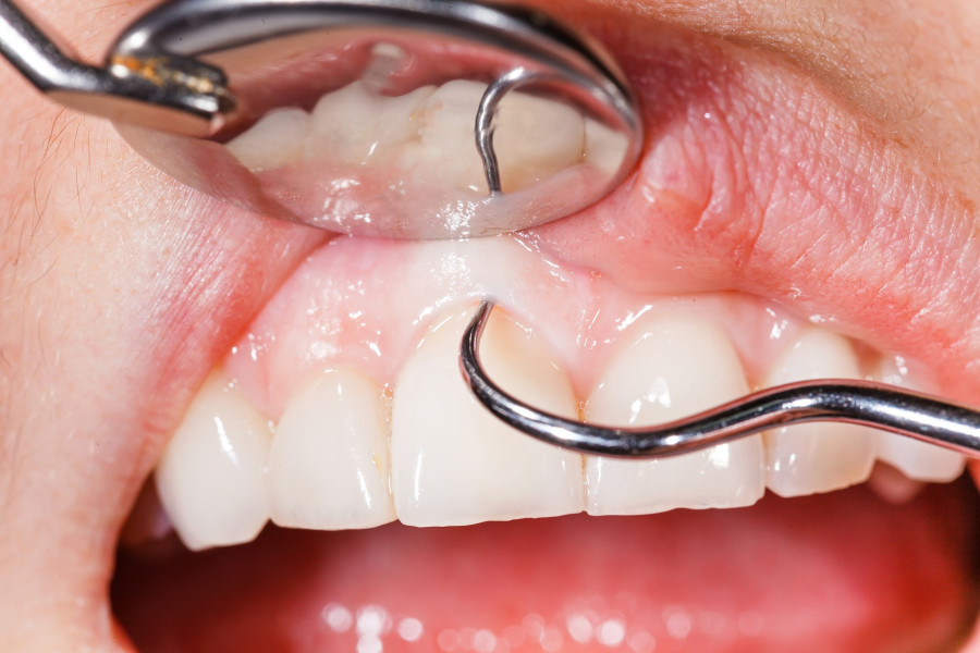 Dental-Examination-gums-teeth
