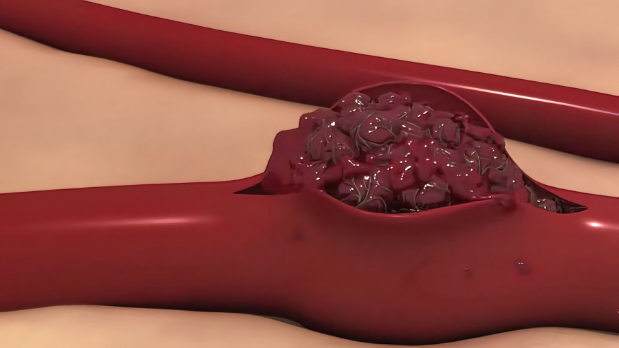Aneurysma