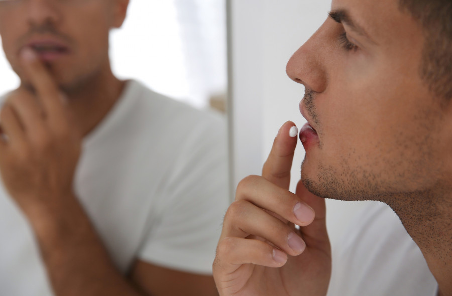 Oral-Herpes-Cream-Lips