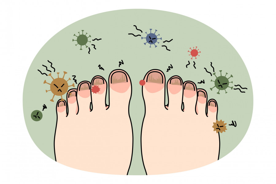 Person Feet With Nail Disease Or Infection. Foot With Onychomycosis Or Fungus On Fingers. Medical Tr