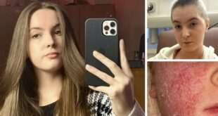Η Bethany Gamble ξεκίνησε να χρησιμοποιεί στεροειδείς κρέμες από την ηλικία των δύο ετών για να ελέγξει το έκζεμά της / FACEBOOK